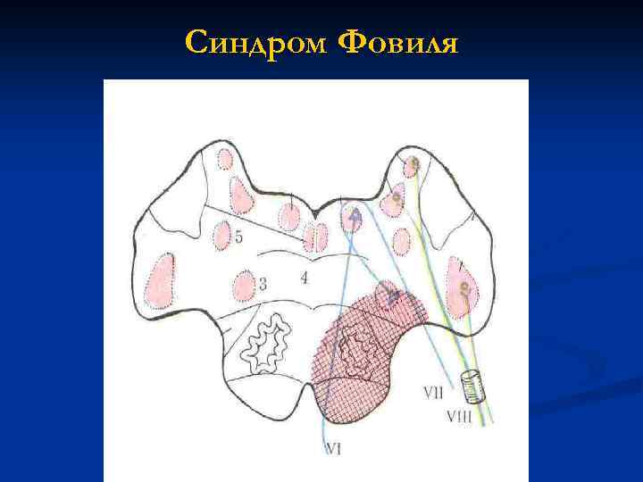 Синдром Фовиля 