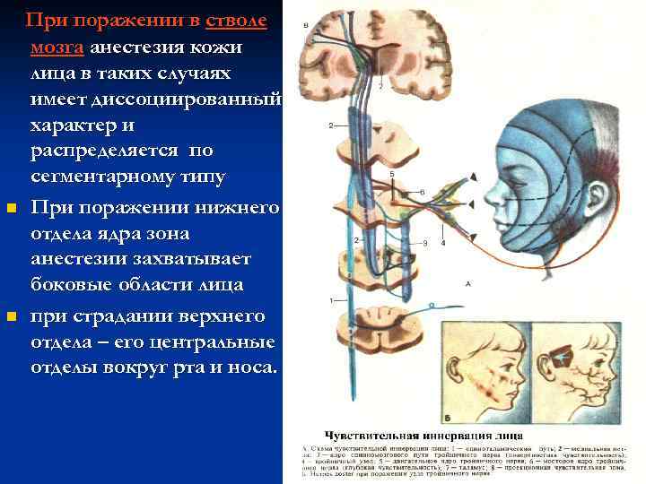 n n При поражении в стволе мозга анестезия кожи лица в таких случаях имеет