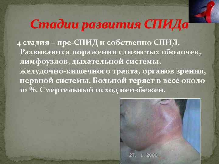 Стадии развития СПИДа 4 стадия – пре-СПИД и собственно СПИД. Развиваются поражения слизистых оболочек,