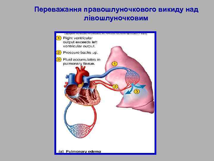Переважання правошлуночкового викиду над лівошлуночковим 