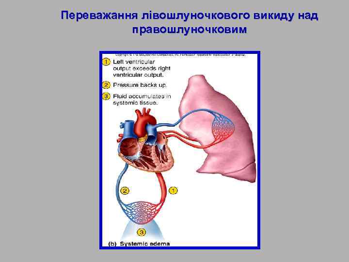 Переважання лівошлуночкового викиду над правошлуночковим 