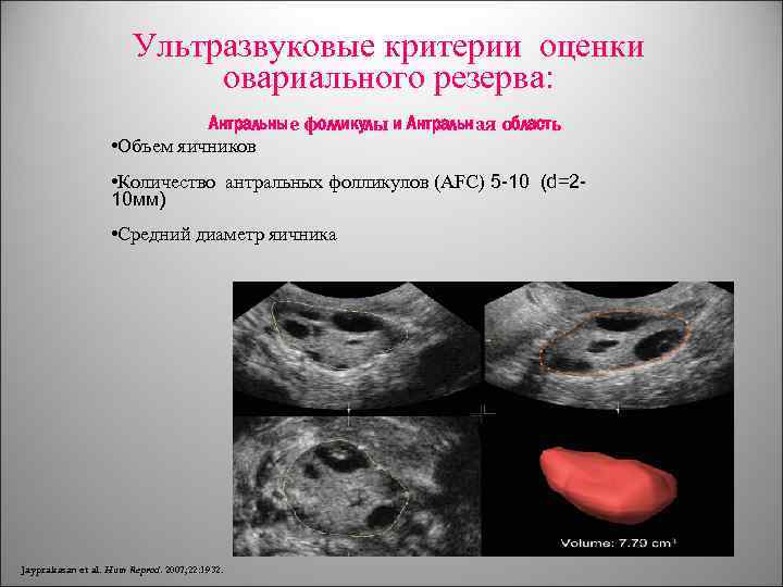 Ультразвуковые критерии оценки овариального резерва: Антральные фолликулы и Антральная область • Объем яичников •