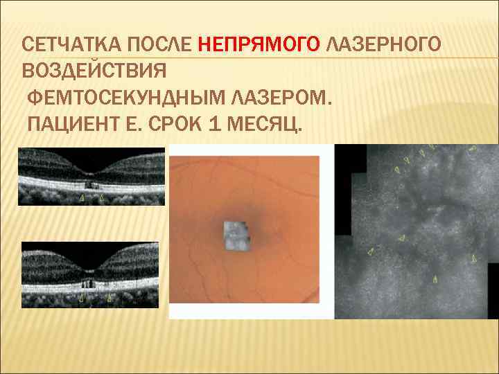 СЕТЧАТКА ПОСЛЕ НЕПРЯМОГО ЛАЗЕРНОГО ВОЗДЕЙСТВИЯ ФЕМТОСЕКУНДНЫМ ЛАЗЕРОМ. ПАЦИЕНТ Е. СРОК 1 МЕСЯЦ. 