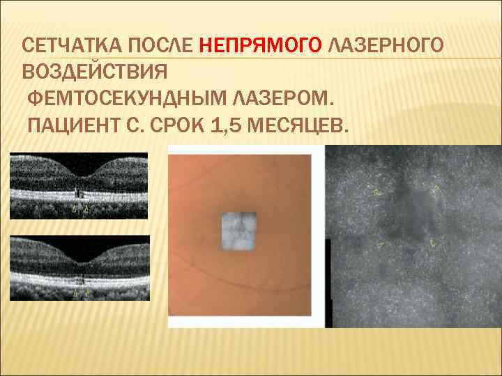 СЕТЧАТКА ПОСЛЕ НЕПРЯМОГО ЛАЗЕРНОГО ВОЗДЕЙСТВИЯ ФЕМТОСЕКУНДНЫМ ЛАЗЕРОМ. ПАЦИЕНТ С. СРОК 1, 5 МЕСЯЦЕВ. 