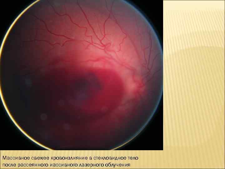 Массивное свежее кровоизлияние в стекловидное тело после рассеянного иассивного лазерного облучения 