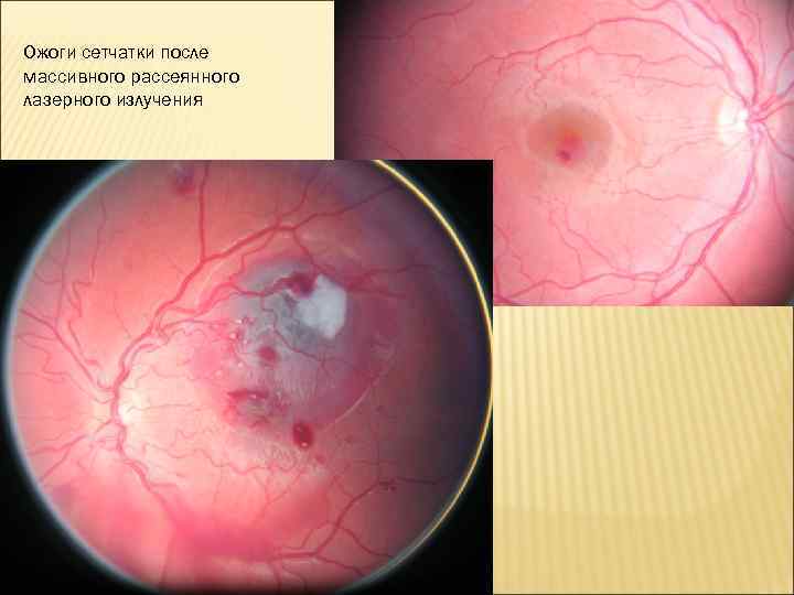 Ожоги сетчатки после массивного рассеянного лазерного излучения 