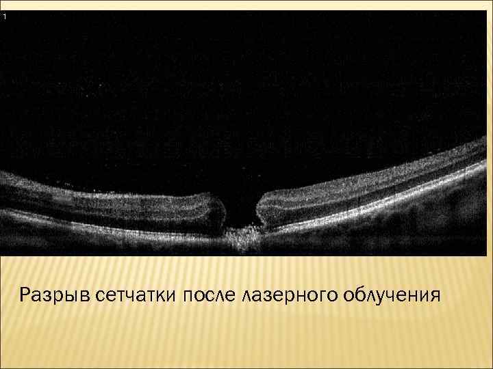 Разрыв сетчатки после лазерного облучения 