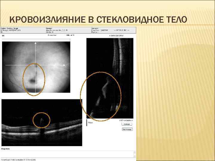 КРОВОИЗЛИЯНИЕ В СТЕКЛОВИДНОЕ ТЕЛО 