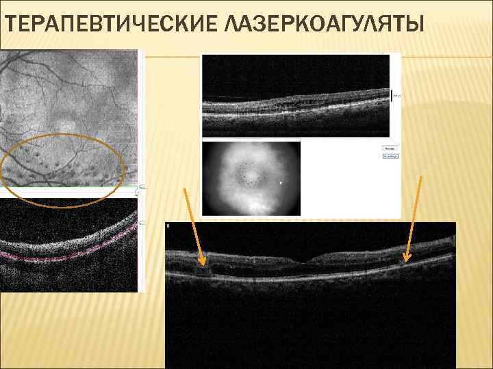 ТЕРАПЕВТИЧЕСКИЕ ЛАЗЕРКОАГУЛЯТЫ 