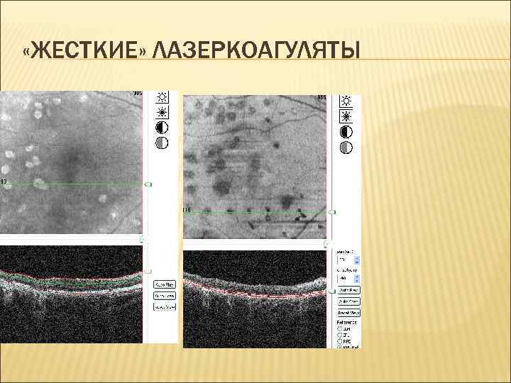  «ЖЕСТКИЕ» ЛАЗЕРКОАГУЛЯТЫ 