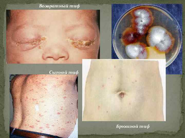 Возвратный тиф Сыпной тиф Брюшной тиф 