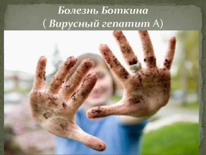 Болезнь Боткина ( Вирусный гепатит А) 