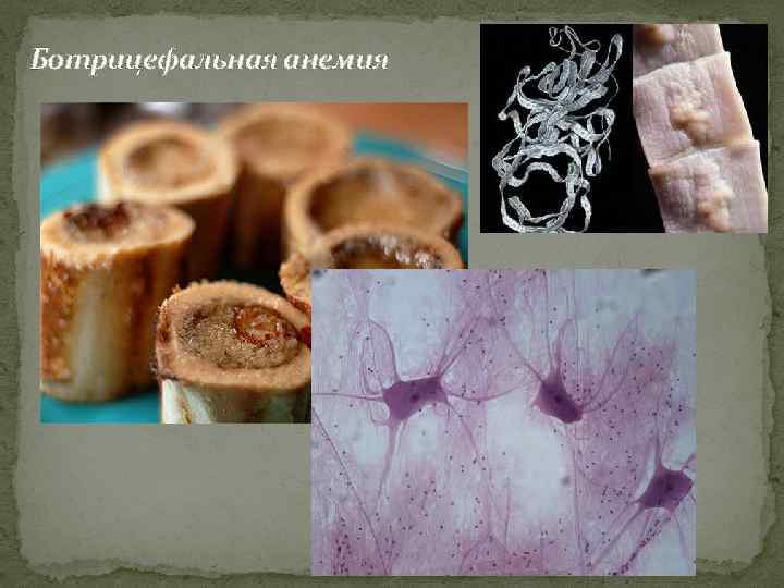 Ботрицефальная анемия 