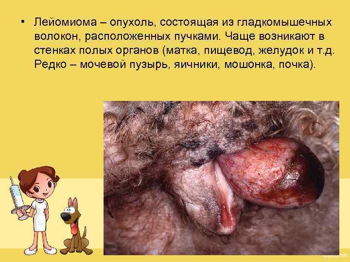  • Лейомиома – опухоль, состоящая из гладкомышечных волокон, расположенных пучками. Чаще возникают в