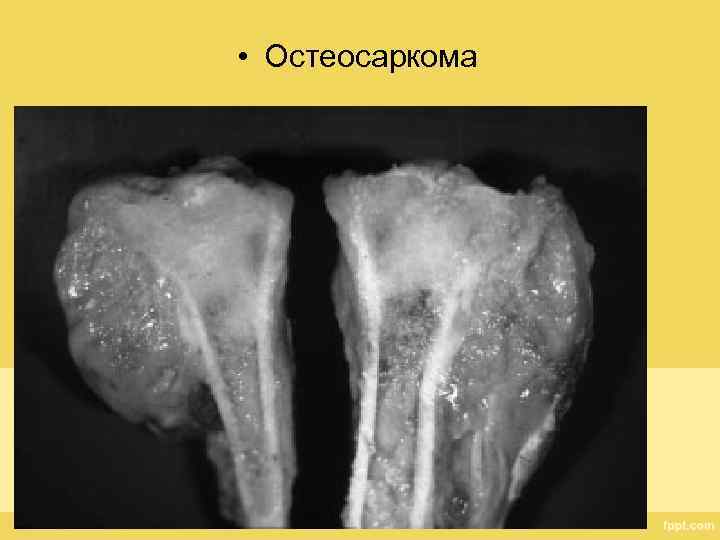  • Остеосаркома 