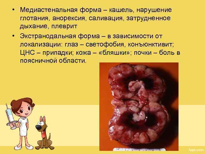  • Медиастенальная форма – кашель, нарушение глотания, анорексия, саливация, затрудненное дыхание, плеврит •
