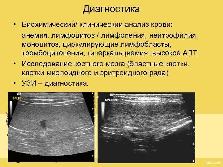 Диагностика • Биохимический/ клинический анализ крови: анемия, лимфоцитоз / лимфопения, нейтрофилия, моноцитоз, циркулирующие лимфобласты,