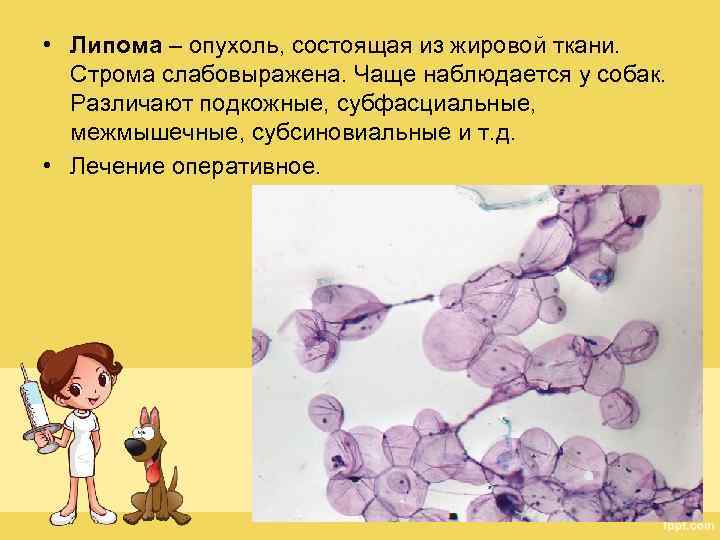  • Липома – опухоль, состоящая из жировой ткани. Строма слабовыражена. Чаще наблюдается у