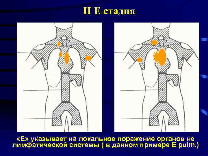 II E стадия «Е» указывает на локальное поражение органов не лимфатической системы ( в