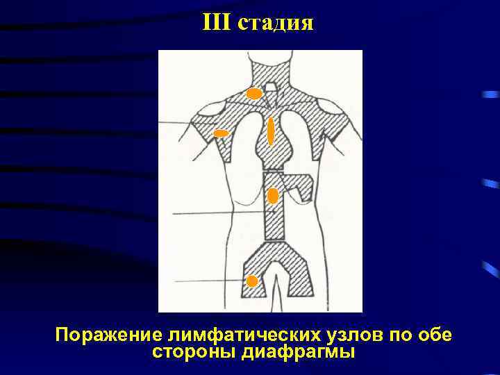 III стадия Поражение лимфатических узлов по обе стороны диафрагмы 
