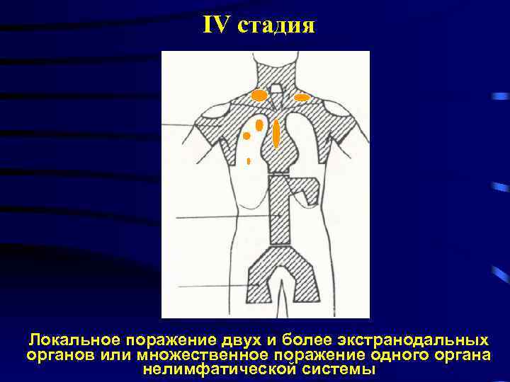 IV стадия Локальное поражение двух и более экстранодальных органов или множественное поражение одного органа