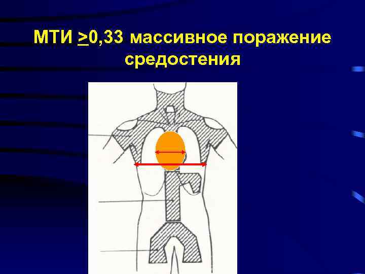 МТИ >0, 33 массивное поражение средостения 