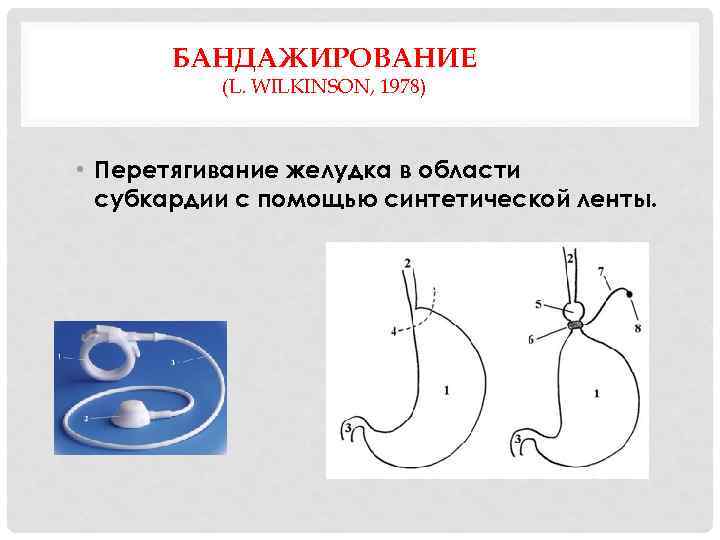 БАНДАЖИРОВАНИЕ (L. WILKINSON, 1978) • Перетягивание желудка в области субкардии с помощью синтетической ленты.