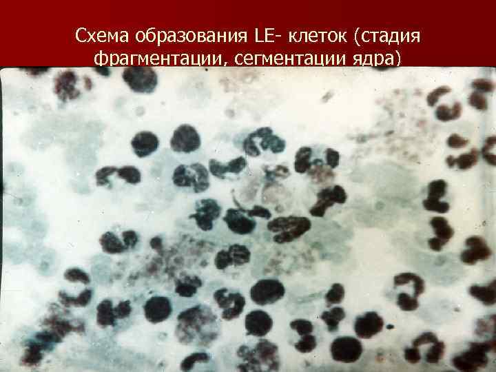Схема образования LE клеток (стадия фрагментации, сегментации ядра) 