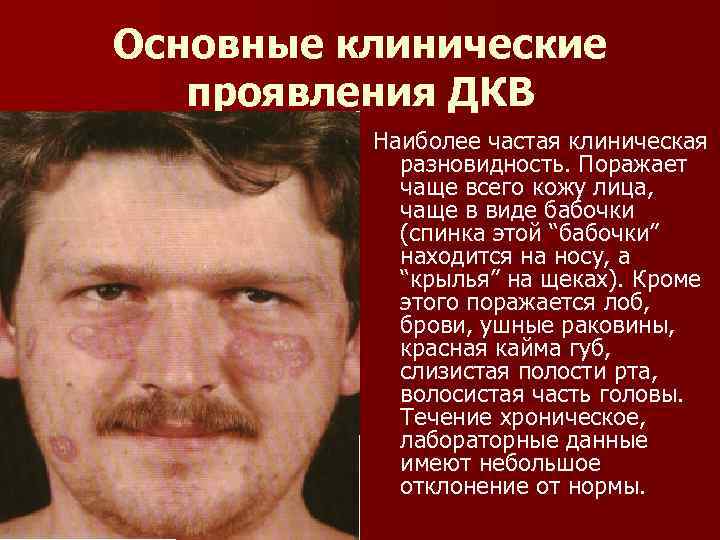 Основные клинические проявления ДКВ Наиболее частая клиническая разновидность. Поражает чаще всего кожу лица, чаще