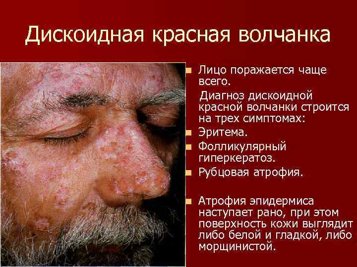 Дискоидная красная волчанка n n n Лицо поражается чаще всего. Диагноз дискоидной красной волчанки