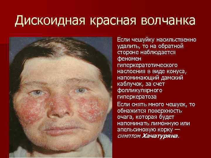 Дискоидная красная волчанка Если чешуйку насильственно удалить, то на обратной стороне наблюдается феномен гиперкератотического