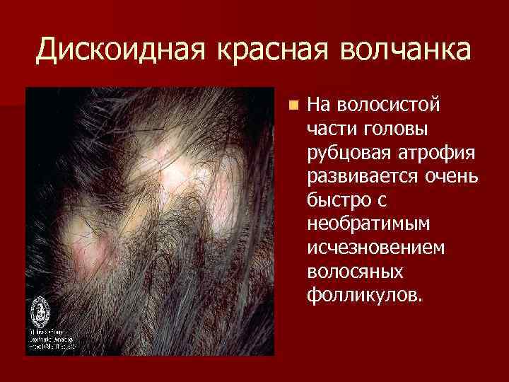 Дискоидная красная волчанка n На волосистой части головы рубцовая атрофия развивается очень быстро с