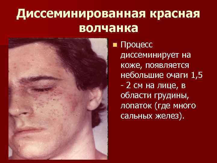 Диссеминированная красная волчанка n Процесс диссеминирует на коже, появляется небольшие очаги 1, 5 2