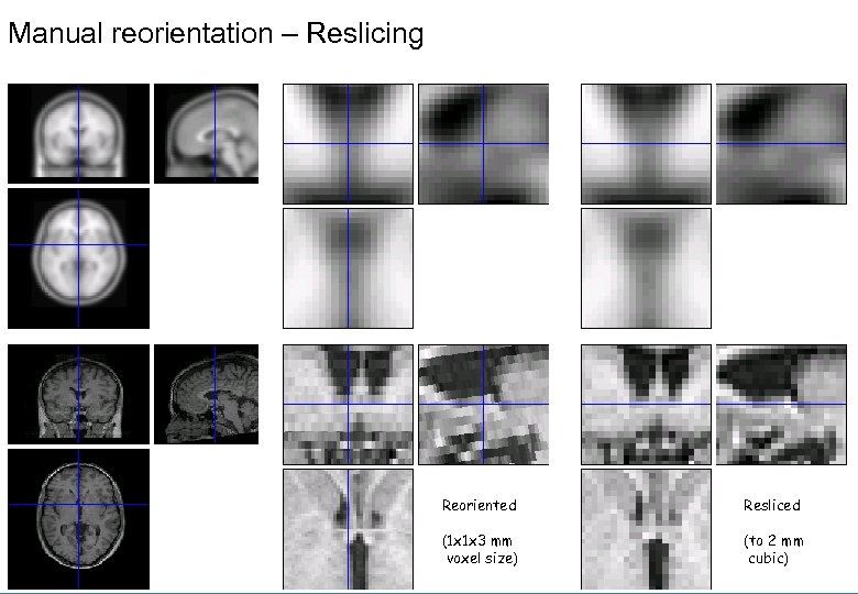 Manual reorientation – Reslicing Reoriented Resliced (1 x 1 x 3 mm voxel size)