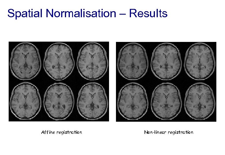 Spatial Normalisation – Results Affine registration Non-linear registration 