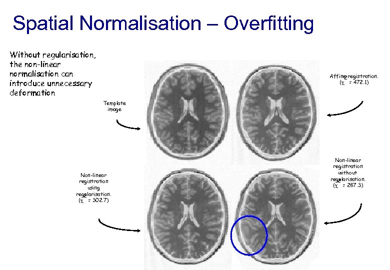 Spatial Normalisation – Overfitting Without regularisation, the non-linear normalisation can introduce unnecessary deformation Affine