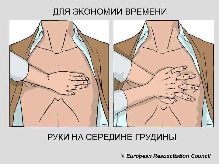 ДЛЯ ЭКОНОМИИ ВРЕМЕНИ РУКИ НА СЕРЕДИНЕ ГРУДИНЫ © European Resuscitation Council 