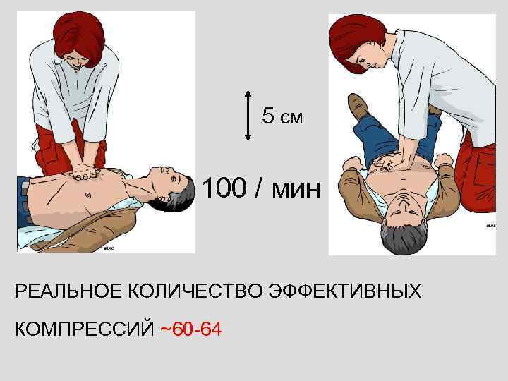 5 см 100 / мин РЕАЛЬНОЕ КОЛИЧЕСТВО ЭФФЕКТИВНЫХ КОМПРЕССИЙ ~60 -64 
