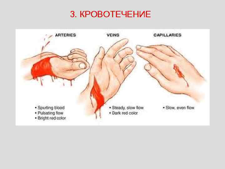 3. КРОВОТЕЧЕНИЕ 