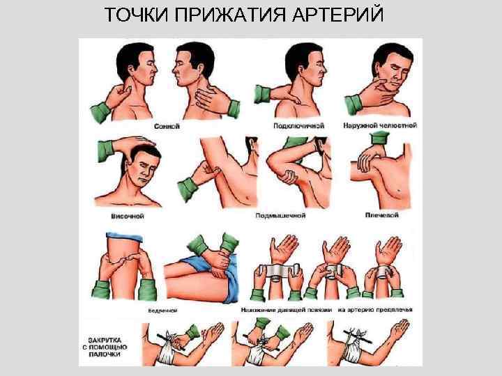 ТОЧКИ ПРИЖАТИЯ АРТЕРИЙ 