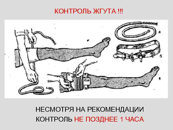 КОНТРОЛЬ ЖГУТА !!! НЕСМОТРЯ НА РЕКОМЕНДАЦИИ КОНТРОЛЬ НЕ ПОЗДНЕЕ 1 ЧАСА 