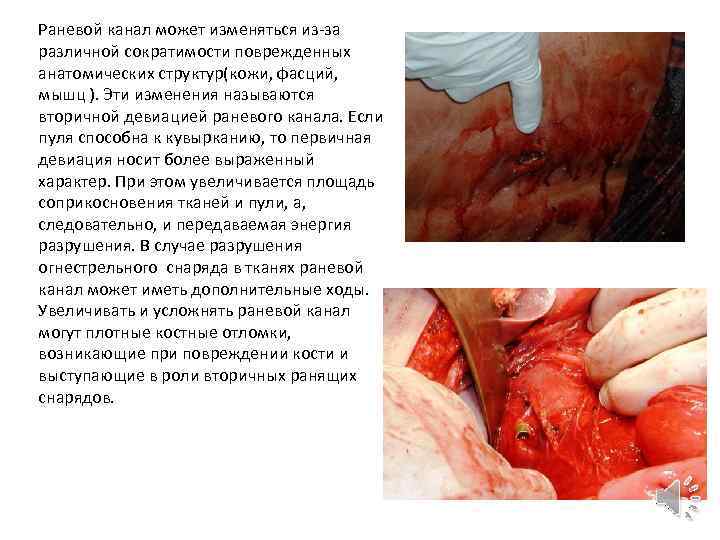 Раневой канал может изменяться из-за различной сократимости поврежденных анатомических структур(кожи, фасций, мышц ). Эти