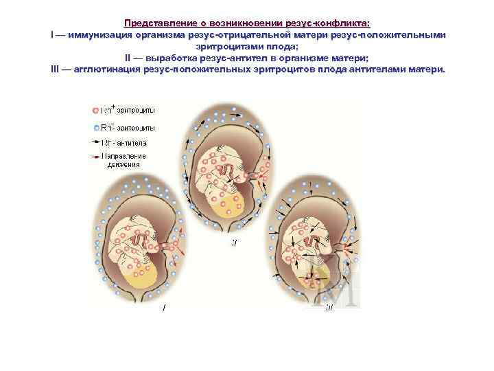 Представление о возникновении резус-конфликта: I — иммунизация организма резус-отрицательной матери резус-положительными эритроцитами плода; II