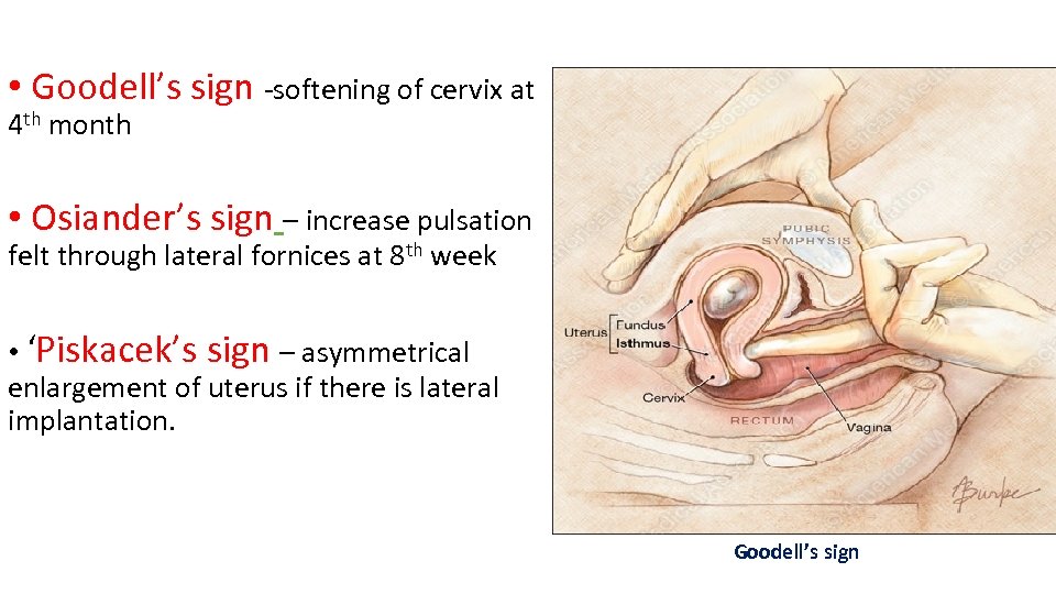  • Goodell’s sign -softening of cervix at 4 th month • Osiander’s sign