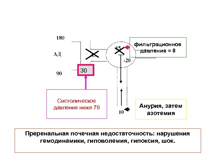 фильтрационное давление = 0 30 Систолическое давление ниже 70 Анурия, затем азотемия Преренальная почечная