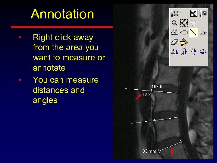 Annotation • • Right click away from the area you want to measure or