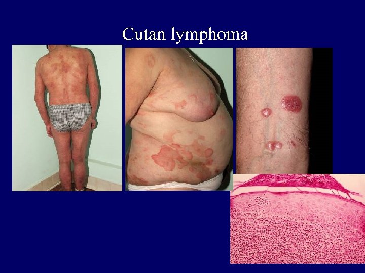 Cutan lymphoma 