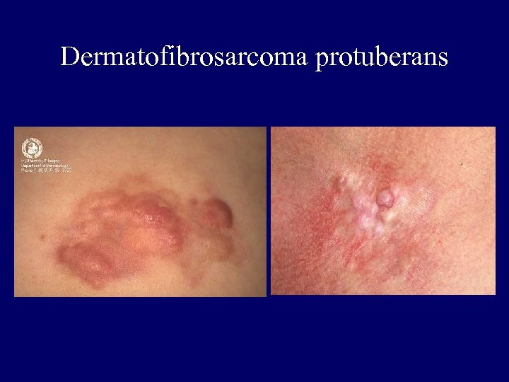 Dermatofibrosarcoma protuberans 