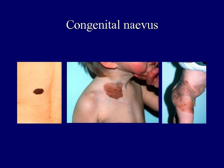 Congenital naevus 