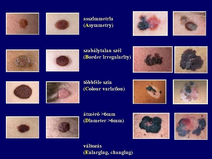 asszimmetria (Asymmetry) szabálytalan szél (Border irregularity) többféle szín (Colour variation) átmérő >6 mm (Diameter
